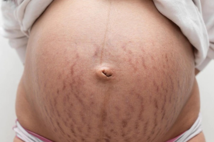 cara menghilangkan stretch marks ibu hamil