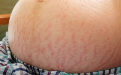 Kurangi Stretch Mark Saat Hamil Pakai Cara Ini!