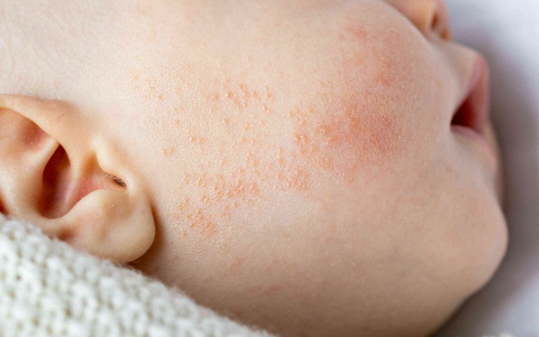 Terdapat Gejala Alergi pada Anak? Kenali Ciri Alergi pada Bayi Berikut Ini