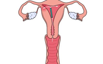 Ketahui Ciri-Ciri IUD Bergeser dan Bagaimana Penanganannya