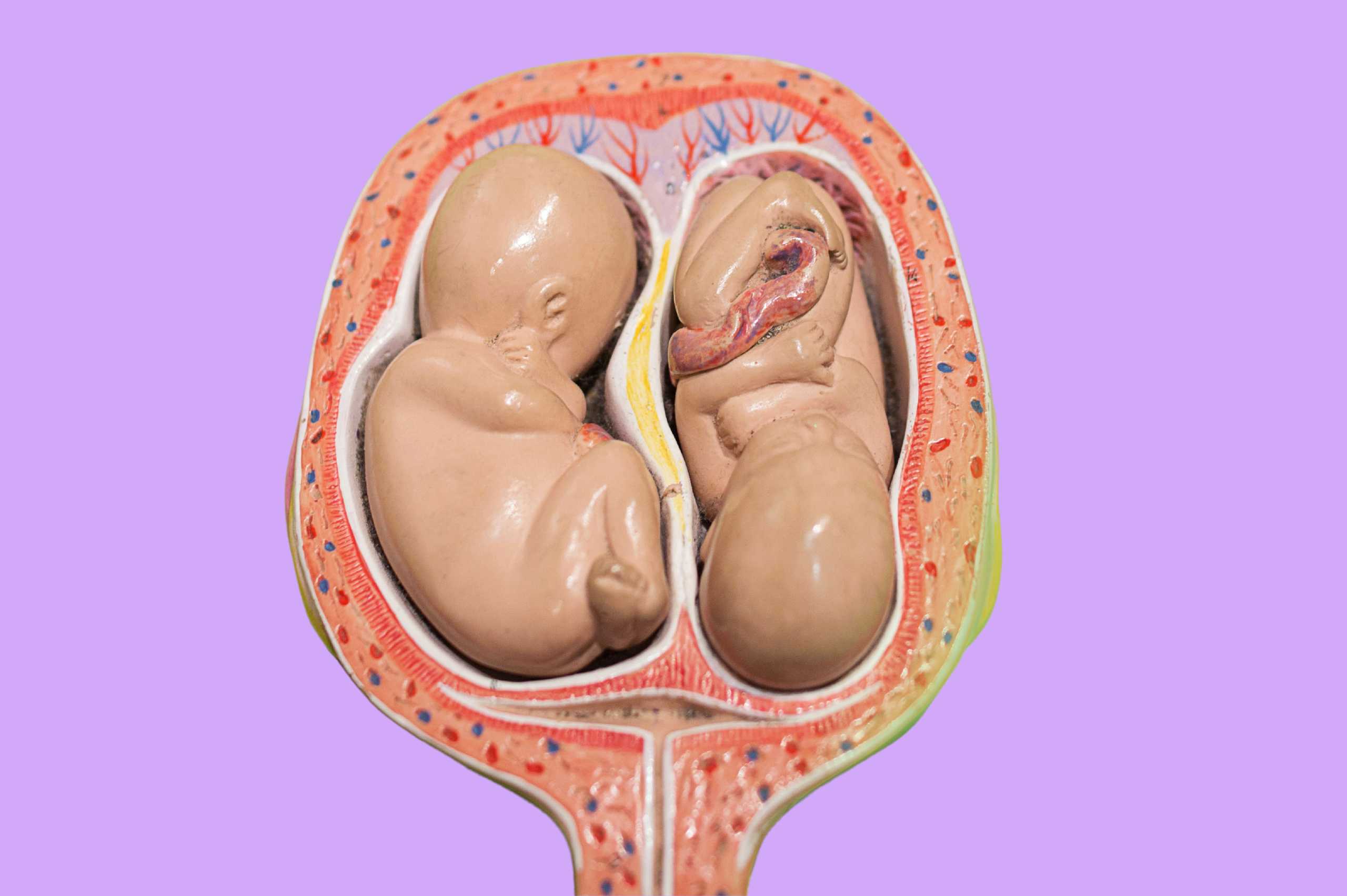 ciri ciri hamil anak kembar