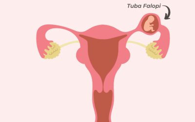 Ketahui Penyebab dan Gejala Kehamilan Ektopik