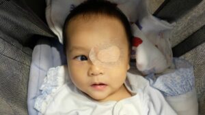 retinoblastoma
