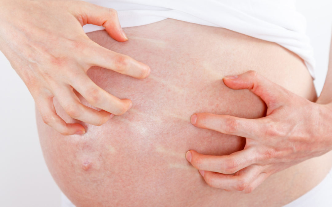 Tips Mengatasi Gatal pada Ibu Hamil Trimester 3 Secara Alami