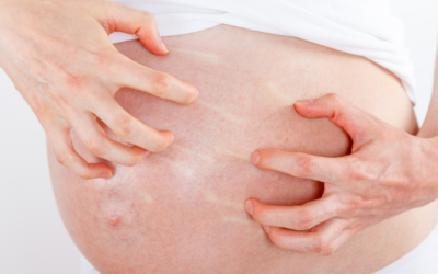 Tips Mengatasi Gatal pada Ibu Hamil Trimester 3 Secara Alami
