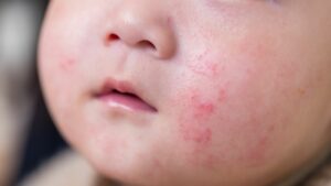 penyakit kulit bernanah pada anak​