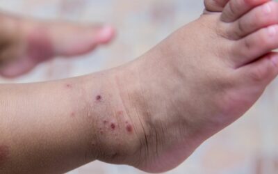 HFMD Adalah Penyakit yang Sering Muncul di Musim Panas?