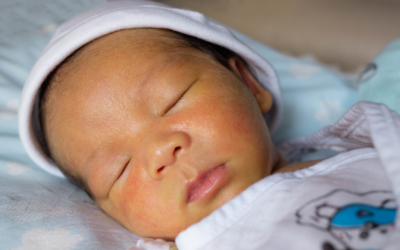 Ikterus Adalah Warna Kuning pada Kulit Bayi, Apa Penyebabnya?
