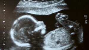 janin down syndrome aktif atau tidak