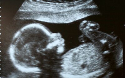 Janin Down Syndrome Aktif atau Tidak? Ini Penjelasan Medisnya!