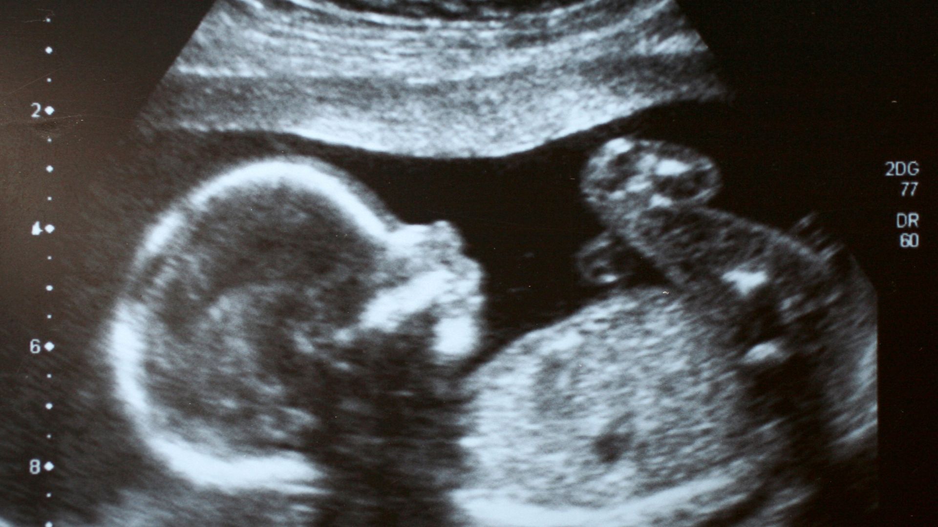 janin down syndrome aktif atau tidak