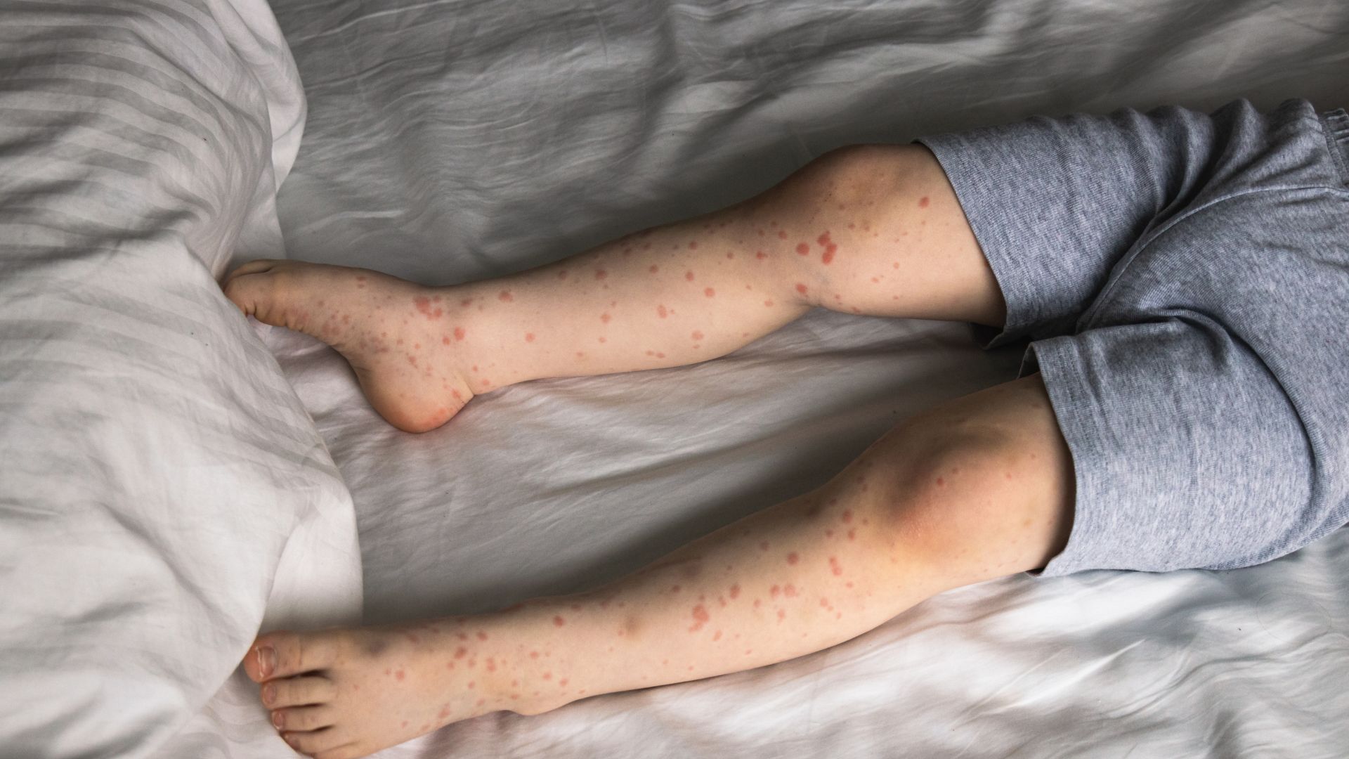 Apakah Roseola Infantum dapat Disembuhkan roseola infantum