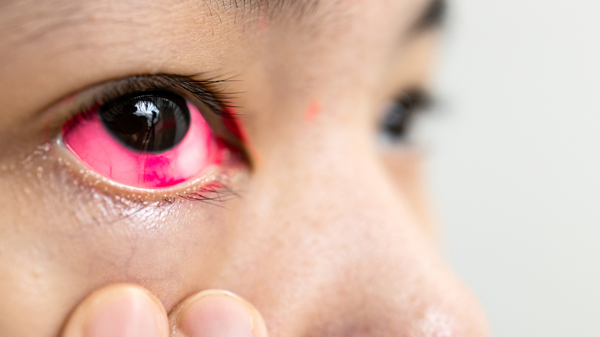 Bagaimana Cara Konjungtivitis Menular konjungtivitis