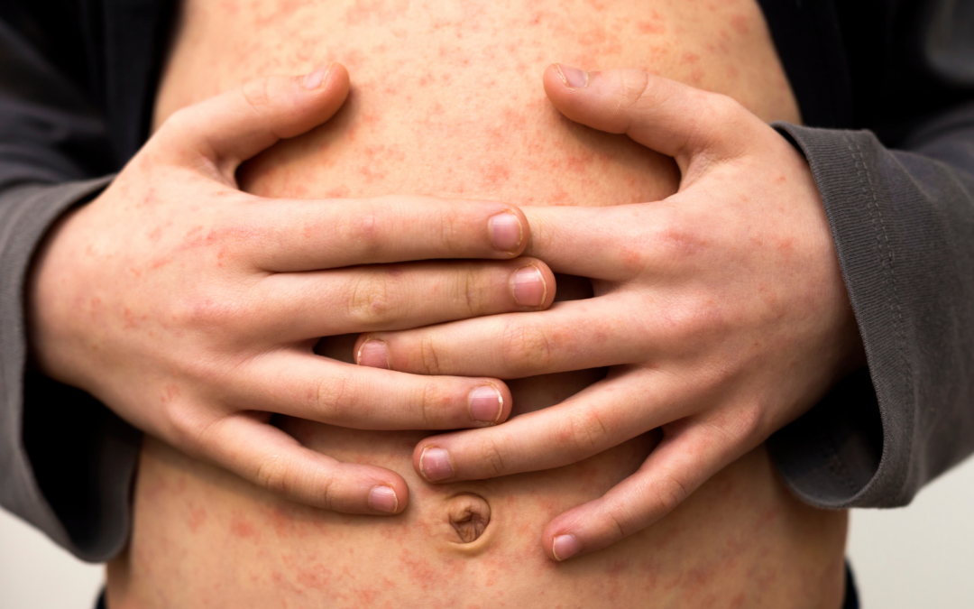 Campak Jerman adalah Infeksi Virus: Kenali Dampaknya pada Anak!