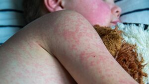 roseola infantum