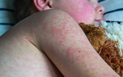 Roseola Infantum pada Bayi: Apa Itu dan Bagaimana Mengatasinya?