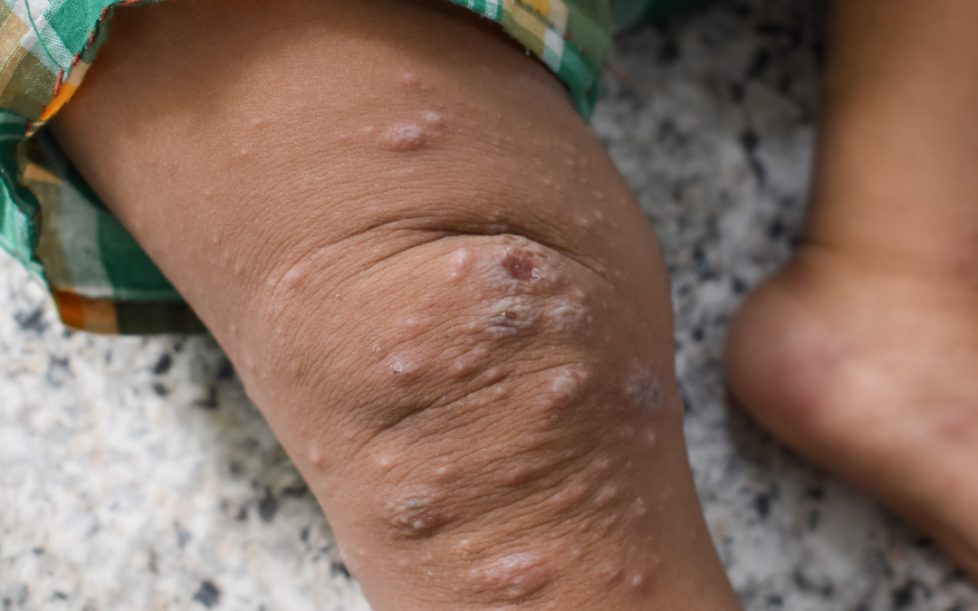 Skabies adalah Infeksi Kulit Gatal, Ini Tanda-Tandanya pada Anak