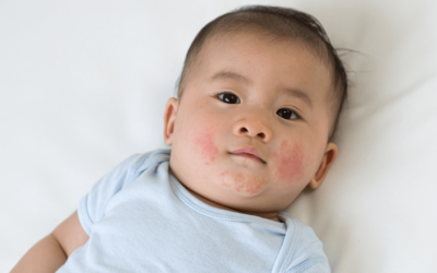 9 Jenis Infeksi Kulit pada Bayi yang Harus Dikenali Mom dan Ayah!