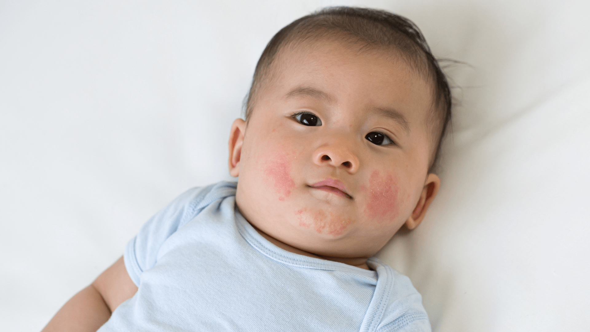 9 Jenis Infeksi Kulit pada Bayi yang Harus Dikenali Mom dan Ayah!-min infeksi kulit pada bayi