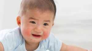 biduran pada anak