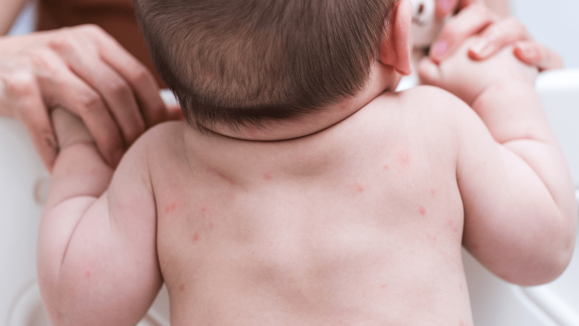 infeksi kulit pada anak​