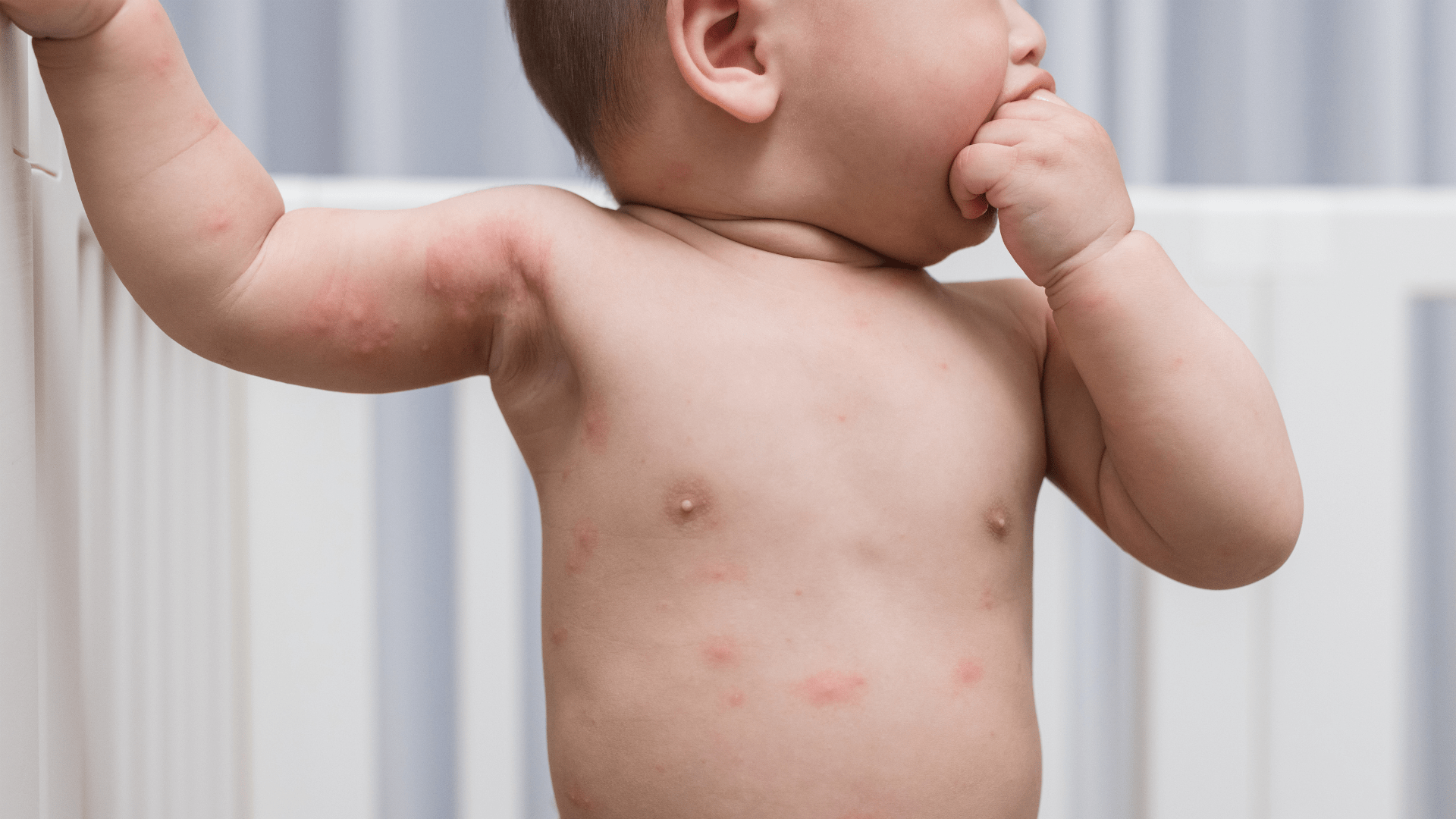 Waspadai Infeksi Kulit pada Anak, Ini Ciri dan Penanganannya-min Penyebab Infeksi Kulit pada Anak Infeksi kulit pada anak terjadi karena adanya kuman, bakteri, virus, jamur, hingga parasit yang ada di dalam kulit. Anak-anak mudah terkena infeksi karena sistem kekebalan tubuh mereka belum berkembang dengan sempurna sehingga tubuh belum mampu melawan kuman dengan baik. Aktivitas fisik dan kontak langsung saat bermain membuat kuman mudah menyebar dan meningkatkan risiko infeksi bakteri pada kulit anak. Kebiasaan sederhana seperti tidak mencuci tangan setelah bermain juga bisa menjadi penyebabnya. Selain itu, virus moluskum kontagiosum dapat menular melalui kontak kulit dengan penderita, sedangkan tungau bisa berpindah lewat kontak dekat atau penggunaan tempat tidur yang sama. Jenis Infeksi Kulit yang Sering Terjadi pada Anak Beberapa jenis infeksi bakteri pada kulit anak yang sering terjadi di antaranya moluskum kontagiosum, kutil virus, impetigo, tinea kapitis, dan masih banyak jenis lainnya. Berikut jenis infeksi kulit yang umum dialami anak dan perlu diwaspadai agar bisa mendapatkan penanganan yang tepat sejak dini: 1. Moluskum Kontagiosum Jenis penyakit kulit ini terjadi karena adanya infeksi virus yang disebabkan oleh poxvirus dan biasanya menyerang anak di usia 2-5 tahun. Penyakit ini biasanya menular melalui kontak langsung dengan kulit anak yang terinfeksi atau tertular dari barang pribadi seperti handuk dan alat makan. Moluskum kontagiosum memiliki ciri berupa bintik kecil seperti mutiara dengan lekukan di tengah, penyakit ini sembuh selama beberapa bulan. 2. Kutil Virus Kutil virus terjadi karena adanya infeksi human papillomavirus atau HPV, biasanya infeksi ini muncul di tangan atau kaki. Kutil virus tidak menimbulkan bahaya, namun dapat mengganggu dan menular. Pengobatan yang dilakukan seperti menggunakan asam salisilat topikal untuk meredakan kutil virus pada si Kecil. 3. Impetigo Impetigo adalah infeksi kulit yang menyerang anak mulai dari usia 2-6 tahun. Penyakit ini terjadi karena infeksi bakteri staphylococcus aureus atau streptococcus pyogenes. Gejala yang terjadi karena adanya luka kecil yang membentuk kerak kuning di sekitar hidung atau mulut si Kecil. Namun, Mom tenang saja karena penyakit ini dapat diobati dengan antibiotik. 4. Patogenesis Anak yang mengidap dermatitis atopik biasanya lebih mudah mengalami infeksi kulit dibandingkan dengan anak yang sehat. Hal ini terjadi karena penghalang kulit yang rusak, sistem imun si Kecil yang tidak seimbang hingga perubahan mikrobioma kulit. Jika penghalang kulit si Kecil rusak maka air lebih mudah keluar sehingga infeksi bakteri lebih cepat masuk ke dalam kulit. Artikel lainnya: Skabies adalah Infeksi Kulit Gatal, Ini Tanda-Tandanya pada Anak Ciri-Ciri Umum Infeksi Kulit pada Anak Ciri-ciri umum infeksi kulit pada anak tergantung dari penyebabnya, namun tanda gatal yang paling sering terjadi yaitu adanya kemerahan dan ruam di kulit. Anak akan merasakan rasa gatal, nyeri, hingga perih pada kulit yang terkena infeksi. Tanda infeksi bakteri pada kulit anak yang harus diwaspadai Mom memiliki ciri-ciri sebagai berikut: Lepuh berisi cairan atau nanah sehingga menyebabkan infeksi semakin parah. Adanya perubahan warna kulit menjadi gelap atau nyeri di area yang terinfeksi. Adanya cairan atau nanah pada luka. Gatal dan iritasi yang menyebabkan anak terus menggaruk hingga infeksi menyebar. Nyeri dan bengkak terjadi jika kulit terasa hangat saat disentuh. Siapa yang Berisiko Terkena Infeksi Kulit pada Anak? Infeksi kulit pada anak terjadi karena banyak faktor, mulai dari faktor lingkungan hingga kondisi tubuh si Kecil. Berikut faktor yang harus diperhatikan oleh Mom: Iklim tropis: Cuaca panas dan lembab menyebabkan bakteri, jamur, hingga kuman berkembang biak dengan cepat. Kontak fisik yang berlebihan: Jika si Kecil sering berinteraksi dengan anak lain maka kemungkinan infeksi lebih cepat. Kulit sensitif: Jika si Kecil memiliki riwayat eksim atau dermatitis atopik maka sebaiknya Mom lebih waspada menjaga kesehatan kulitnya. Kebersihan yang kurang: Jika si Kecil tidak dibiasakan untuk mencuci tangan maka hal ini meningkatkan risiko penularan. Lingkungan yang padat: Jika Mom dan si Kecil tinggal di tempat ramai penduduk maka penyebaran infeksi menjadi lebih cepat. Sistem imun yang belum matang: Anak di bawah usia 5 tahun rentan terhadap penyakit kulit, hal ini terjadi karena daya tahan tubuhnya belum sempurna. Luka gigitan serangga: Dengan adanya luka maka peluang kuman masuk menjadi lebih cepat. Pakaian yang tidak menyerap keringat: Jika si Kecil selalu menggunakan pakaian ketat maka kulitnya menjadi lembab sehingga hal ini memicu terjadinya infeksi kulit. Artikel lainnya: Cara Mengenali dan Mengatasi Penyakit Kulit Bernanah pada Anak