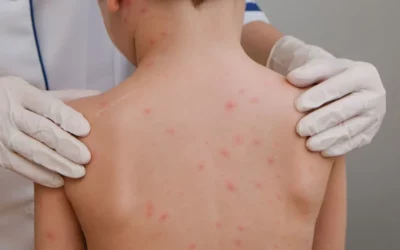 Ciri-Ciri Cacar Air pada Anak: Gejala, Penularan, dan Cara Mengatasinya