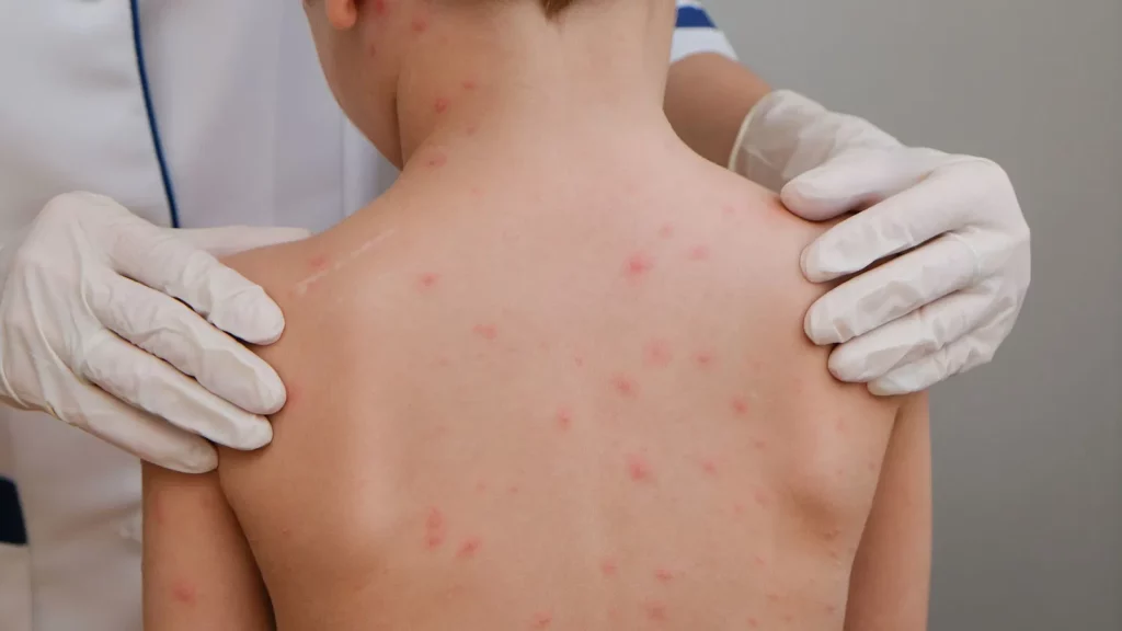 gejala cacar air pada anak