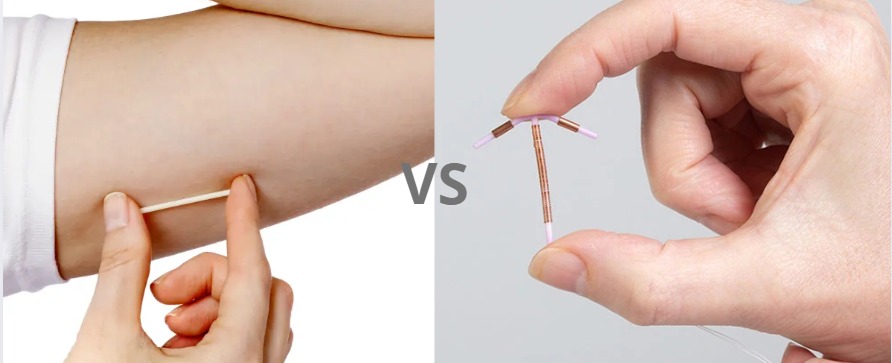 Perbandingan KB Implan dan IUD Non Hormonal: Kelebihan, Kekurangan, dan Efektivitas