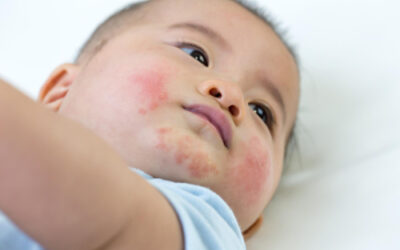 Penyakit Eksim pada Anak : Penyebab, Gejala dan Cara Mengatasinya