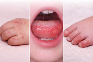 flu singapura pada anak