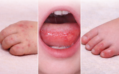 Gejala Flu Singapura pada Anak: Ciri Awal, Penyebab, dan Penanganannya