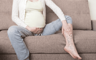 Varises pada Ibu Hamil apakah bisa hilang? Kenali Penyebab dan Cara Mengatasinya!