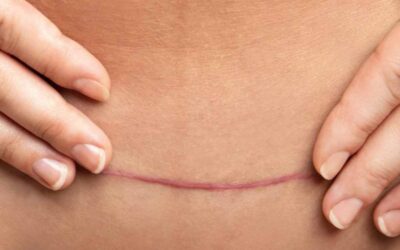 Cara Merawat Luka Jahitan Caesar agar Cepat Kering dan Tidak Infeksi