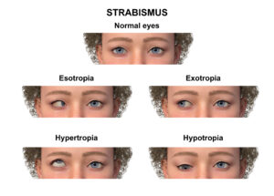 strabismus pada anak