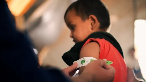 gejala malnutrisi pada anak gejala malnutrisi pada anak