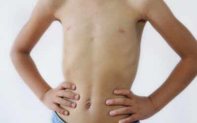 Jenis Malnutrisi pada Anak dan Dampaknya bagi Tumbuh Kembang