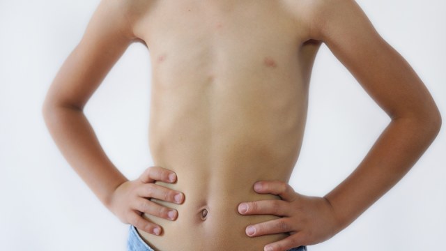 jenis malnutrisi pada anak