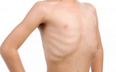 Kenali Penyebab Malnutrisi pada Anak dan Cara Mengatasinya dengan Tepat