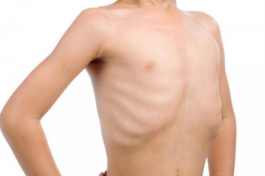 malnutrisi pada anak malnutrisi pada anak