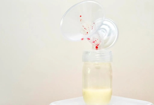 ASI Bercampur Darah saat Pumping, Apakah Aman Diminum Bayi?