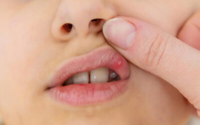 Penyebab Sariawan pada Anak yang Sering Terjadi dan Cara Mengatasinya
