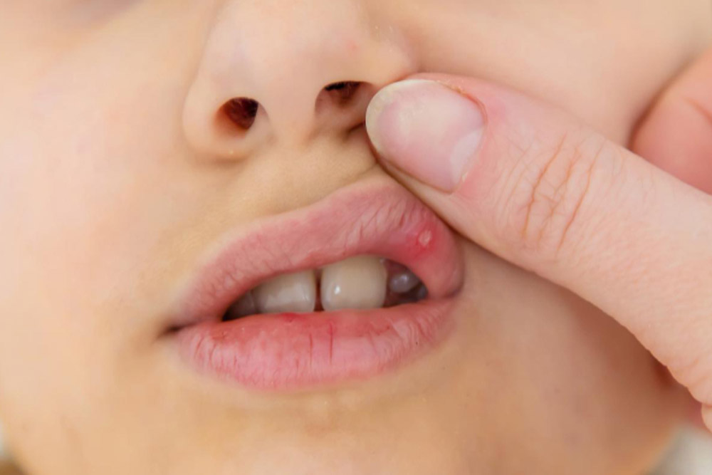 penyebab sariawan anak