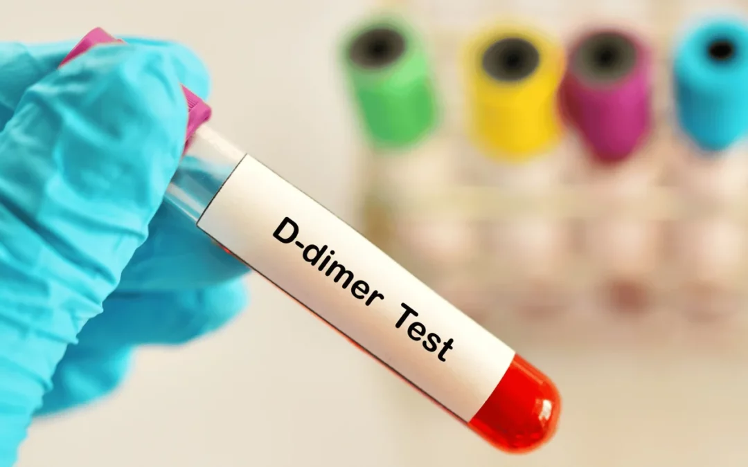 Cek D-Dimer: Untuk Apa dan Kapan Pemeriksaan Ini Dibutuhkan?