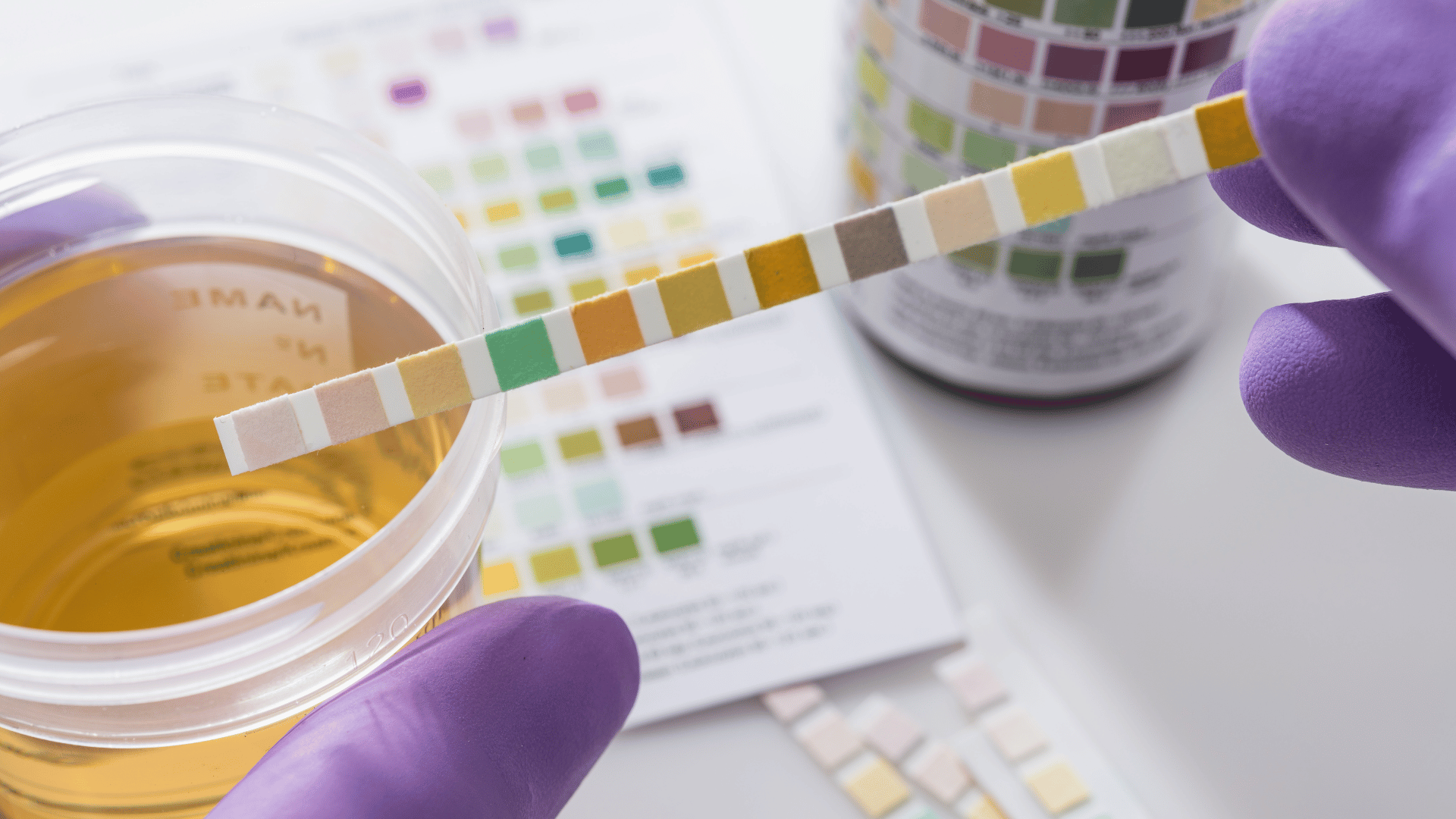 cek protein urine cek protein urine