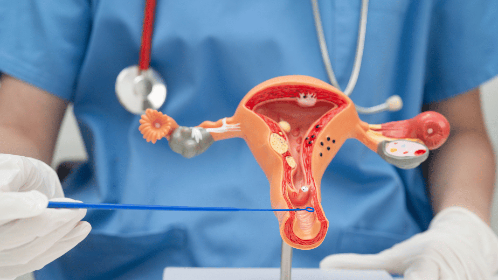 fibroid rahim