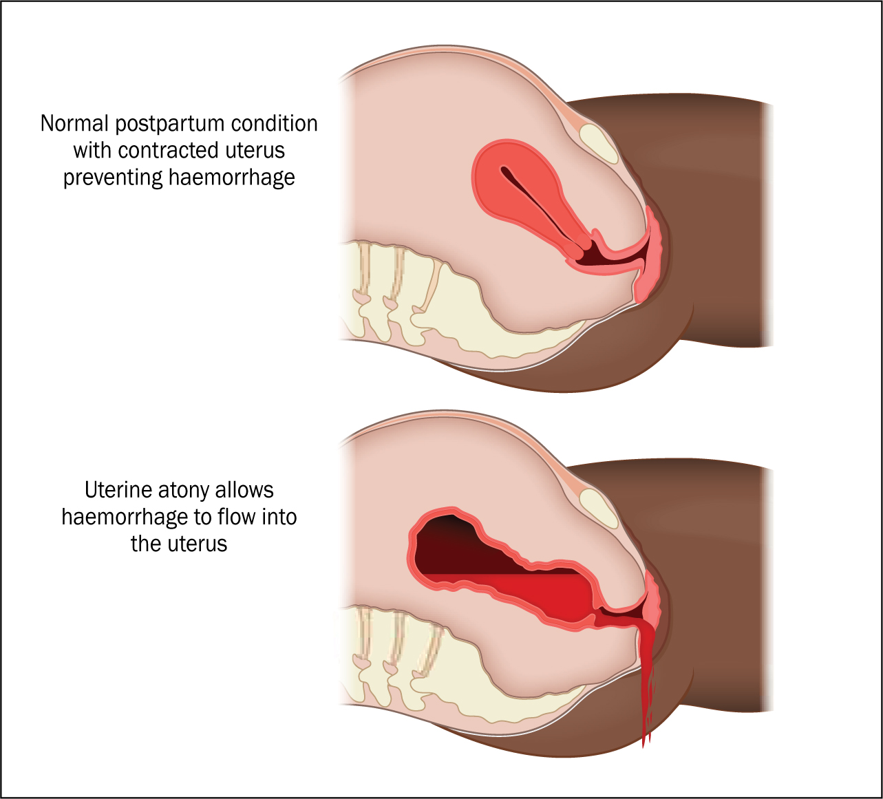 atonia uteri