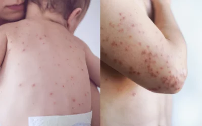 Apa Perbedaan Campak dan Rubella? Kenali Gejalanya